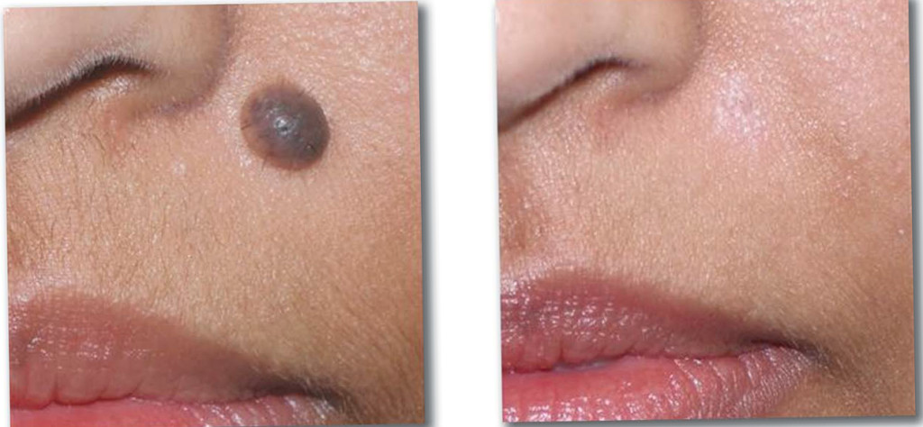 Scarless Mole Removal